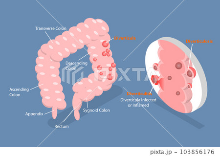3D Isometric Flat Vector Conceptual Illustration of Diverticulitis 3D Isometric Flat Vector Conceptual Illustration of Diverticulitis 103856176