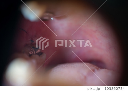 親知らず抜歯と縫合 103860724