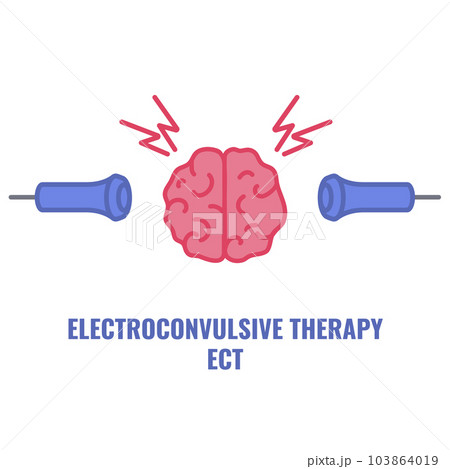 ECT electroconvulsive therapy for severe depression treatment ECT electroconvulsive therapy for severe depression treatment 103864019
