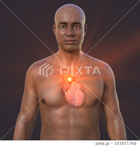 A 3D illustration of the upper half part of an African man with transparent skin, revealing an ascending aortic aneurysm A 3D illustration of the upper half part of an African man with transparent skin, revealing an ascending aortic aneurysm 103871768
