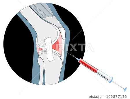injection into the painful joint injection into the painful joint 103877156