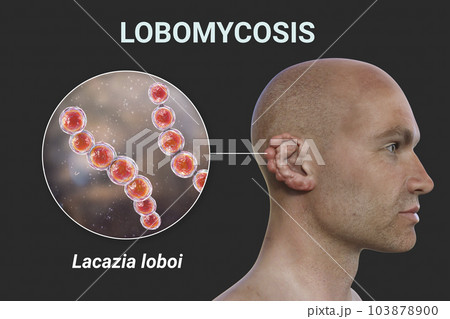 Lobomycosis, a chronic skin disease caused by microscopic fungi Lacazia loboi and characterized by nodular skin lesions, 3D illustration 103878900