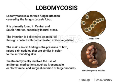 Lobomycosis, a chronic skin disease caused by microscopic fungi Lacazia loboi and characterized by nodular skin lesions, 3D illustration 103878905