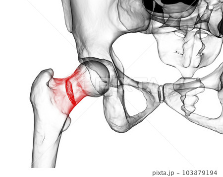 A fracture of the femur neck, a common type of hip fracture that typically occurs in older adults and can lead to mobility issues and other complications, 3D illustration 103879194
