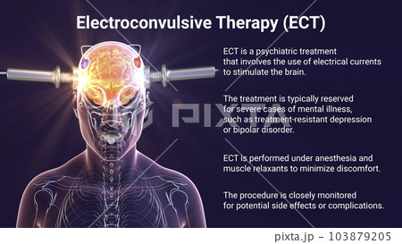 Electroconvulsive therapy, ECT, a treatment involving the use of electrical currents to stimulate the brain, 3D illustration 103879205