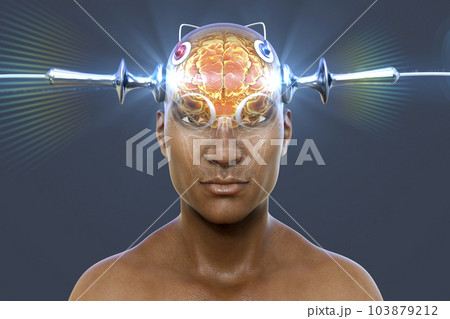 Electroconvulsive therapy, ECT, a treatment involving the use of electrical currents to stimulate the brain, 3D illustration Electroconvulsive therapy, ECT, a treatment involving the use of electrical currents to stimulate the brain, 3D illustration 103879212