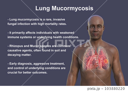 A 3D illustration of the upper half part of an African man with transparent skin, revealing a lung mucormycosis lesion A 3D illustration of the upper half part of an African man with transparent skin, revealing a lung mucormycosis lesion 103880220