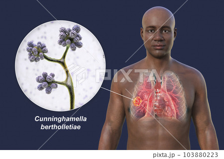 A 3D illustration of the upper half part of an African man with transparent skin, revealing a lung mucormycosis lesion, with close-up view of Cunninghamella bertholletiae fungi A 3D illustration of the upper half part of an African man with transparent skin, revealing a lung mucormycosis lesion, with close-up view of Cunninghamella bertholletiae fungi 103880223