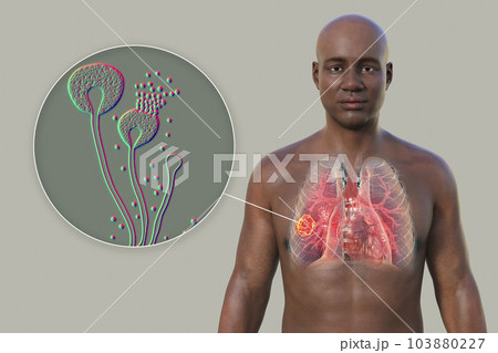 A 3D illustration of the upper half part of an African man with transparent skin, revealing a lung mucormycosis lesion, with close-up view of Mucor fungi A 3D illustration of the upper half part of an African man with transparent skin, revealing a lung mucormycosis lesion, with close-up view of Mucor fungi 103880227