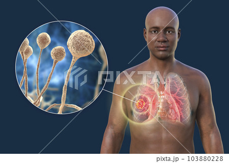 A 3D illustration of the upper half part of an African man with transparent skin, revealing a lung mucormycosis lesion, with close-up view of Mucor fungi 103880228