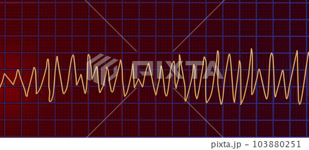 Electrocardiogram ECG displaying Torsades de pointes rhythm, 3D illustration Electrocardiogram ECG displaying Torsades de pointes rhythm, 3D illustration 103880251