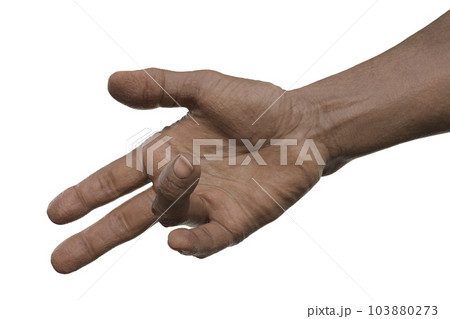 Hand of a male patient with Dupuytren's contracture, photorealistic 3D illustration Hand of a male patient with Dupuytren's contracture, photorealistic 3D illustration 103880273