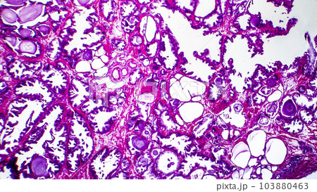 Histopathology of prostate gland hyperplasia 103880463