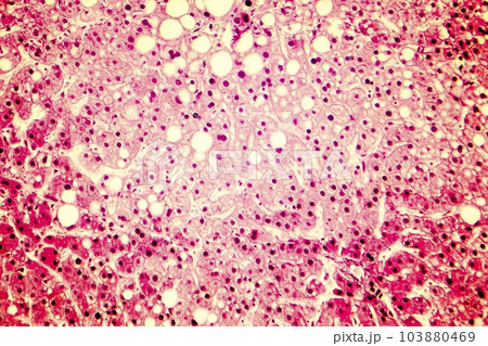 Light micrograph of a fatty liver 103880469