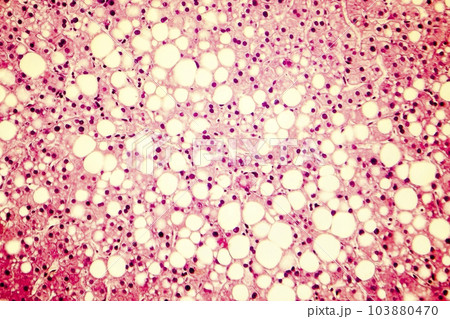 Light micrograph of a fatty liver Light micrograph of a fatty liver 103880470