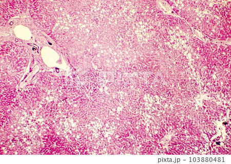Light micrograph of a fatty liver Light micrograph of a fatty liver 103880481