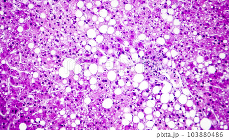 Histopathology of liver steatosis, or fatty liver 103880486