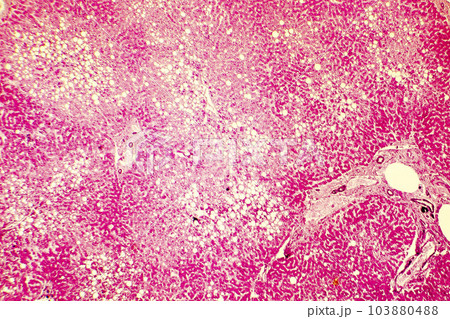 Light micrograph of a fatty liver 103880488