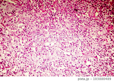 Liquefactive necrosis of the human brain, light photomicrograph 103880489