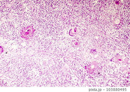 Liquefactive necrosis of the human brain, light photomicrograph Liquefactive necrosis of the human brain, light photomicrograph 103880495