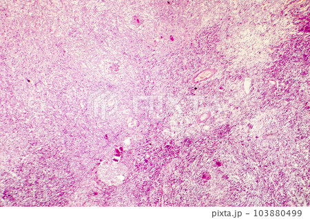 Liquefactive necrosis of the human brain, light photomicrograph 103880499