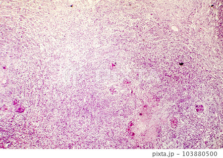 Liquefactive necrosis of the human brain, light photomicrograph Liquefactive necrosis of the human brain, light photomicrograph 103880500