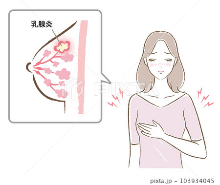 乳腺炎で痛がる女性と、バストの断面図のイラスト 103934045