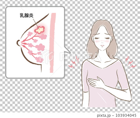 乳腺炎で痛がる女性と、バストの断面図のイラスト 103934045