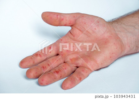 Painful rash, red spots blisters on the hand. Close up Allergy rash, human hands with dermatitis and Health problem. Ill eczema skin of patient. Viral Diseases. Red rashes on the palm. Enterovirus Painful rash, red spots blisters on the hand. Close up Allergy rash, human hands with dermatitis and Health problem. Ill eczema skin of patient. Viral Diseases. Red rashes on the palm. Enterovirus 103943431