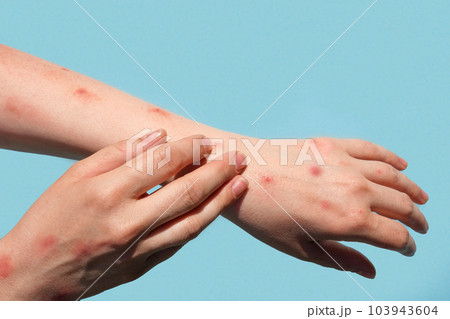 Monkeypox new disease dangerous over the world. Patient with Monkey Pox. Painful rash, red spots blisters on the hand. Close up rash, human hands with Health problem. Banner, copy space Monkeypox new disease dangerous over the world. Patient with Monkey Pox. Painful rash, red spots blisters on the hand. Close up rash, human hands with Health problem. Banner, copy space 103943604