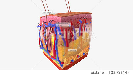 Angioedema is a swelling of the dermis and subcutaneous tissue. Angioedema is a swelling of the dermis and subcutaneous tissue. 103953542