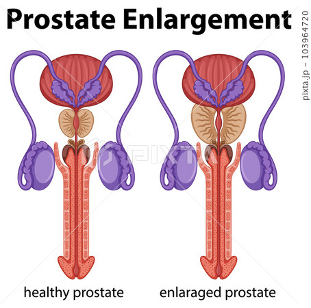 Inside the male reproductive system with prostate enlargement 103964720