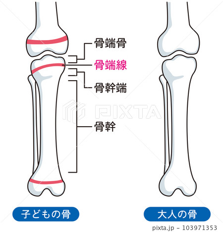 骨端線　子どもの骨と、大人の骨 103971353