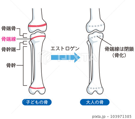 骨端線 子どもの骨と、大人の骨 骨端線 子どもの骨と、大人の骨 103971385