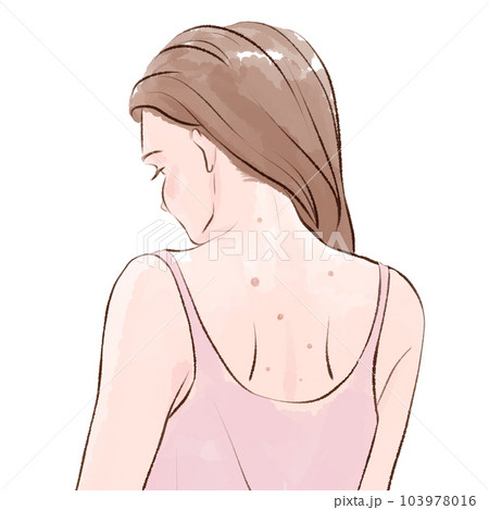 女性の背中の肌荒れ 女性の背中の肌荒れ 103978016