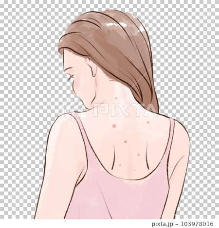 女性の背中の肌荒れ 女性の背中の肌荒れ 103978016