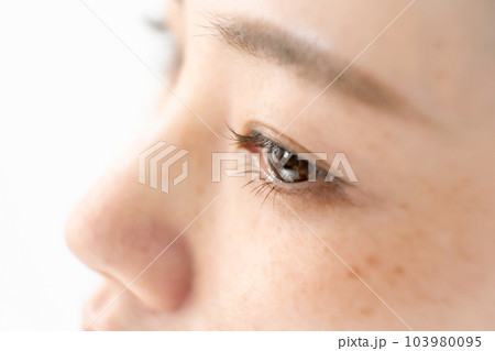 シミ　肝斑　吹き出物　女性 103980095