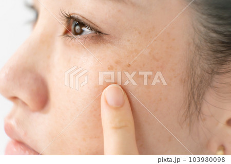 シミ　肝斑　吹き出物　女性 103980098