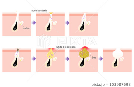Progression of acne Progression of acne 103987698
