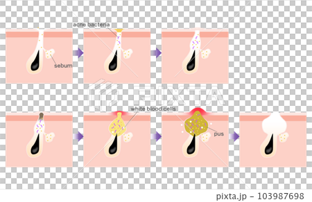 Progression of acne Progression of acne 103987698
