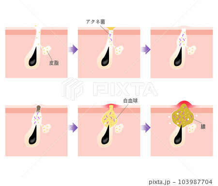 ニキビの進行がわかるシンプルな説明イラスト 103987704