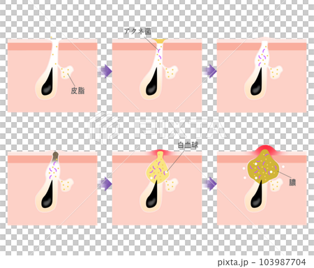 ニキビの進行がわかるシンプルな説明イラスト 103987704