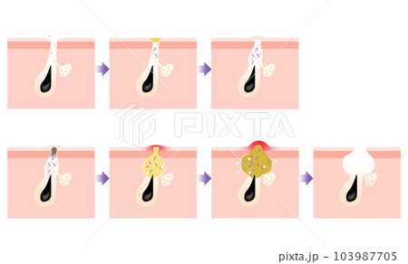 ニキビの進行がわかるシンプルな説明イラスト 103987705