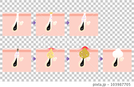 ニキビの進行がわかるシンプルな説明イラスト 103987705