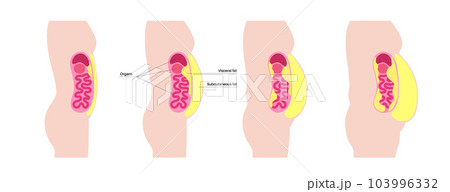 Visceral fat diagram Visceral fat diagram 103996332