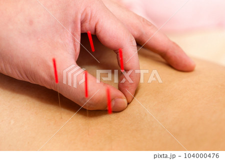 鍼灸・鍼治療 鍼灸・鍼治療 104000476