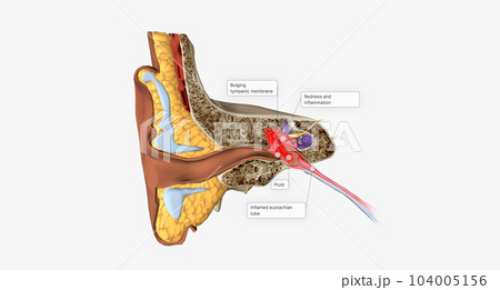 Acute otitis media is an infection and inflammation of the middle ear, usually with fluid behind the tympanic membrane. 104005156