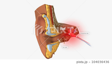 Earache is a general term for pain in the ear. Earache is a general term for pain in the ear. 104036436