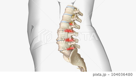 Degenerative disc disease is characterized by the gradual degeneration of the intervertebral discs. 104036480