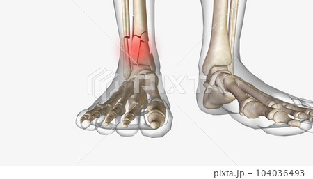 Distal tibia fractures affect the ankle joint and can often involve a fracture of the fibula. 104036493